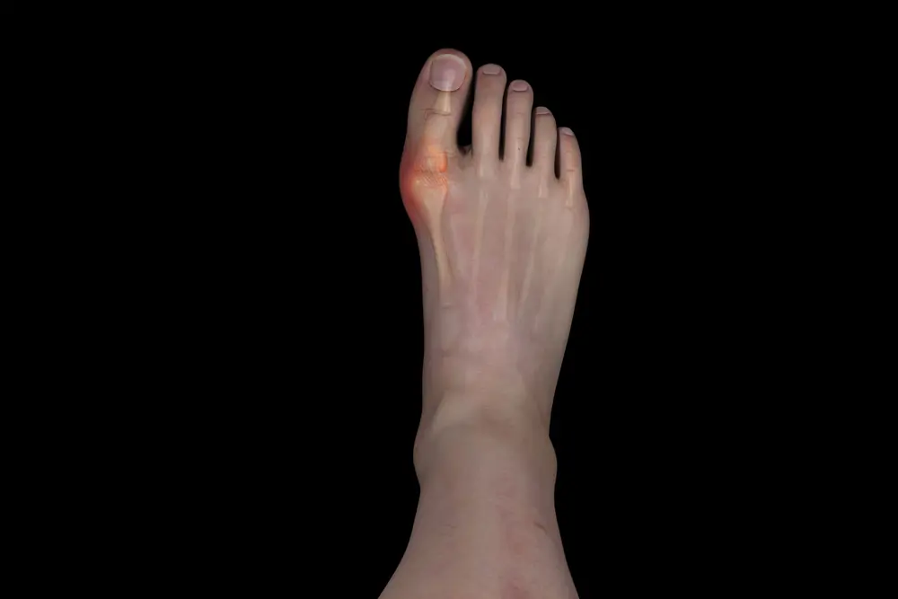 gout what is gout? what are the symptoms of gout?