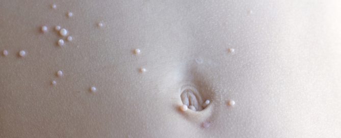 molluscum, ring worm and keratosis pilaris- common skin rashes