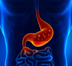 acid reflux