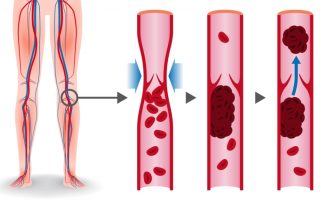 what is a DVT? Learn about the symptoms of a DVT