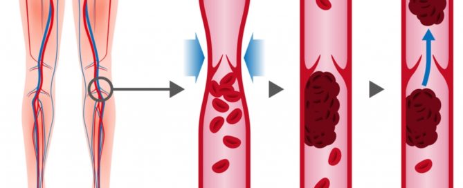 what is a DVT? Learn about the symptoms of a DVT