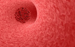 what is a stroke? And what are the signs of a stroke?