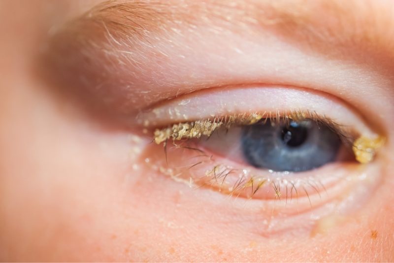 Conjunctivitis Symptoms Causes Treatment Qoctor Your Online Doctor