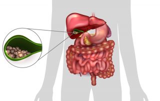 what are gallstones ? what causes gallstones? what are the symptoms of gallstones? what is the treatment for gallstones