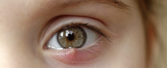 a girl with a stye- what is a stye?