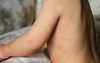 a child with hives, also known as urticaria