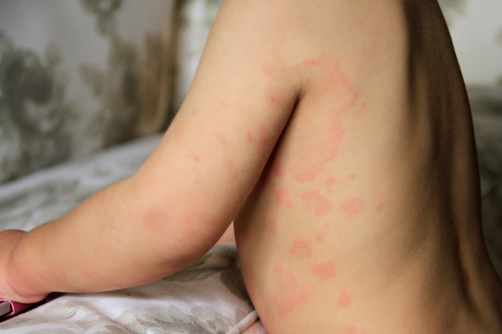 Urticaria Causes Treatment Of Hives Qoctor Your Quick Online Doctor