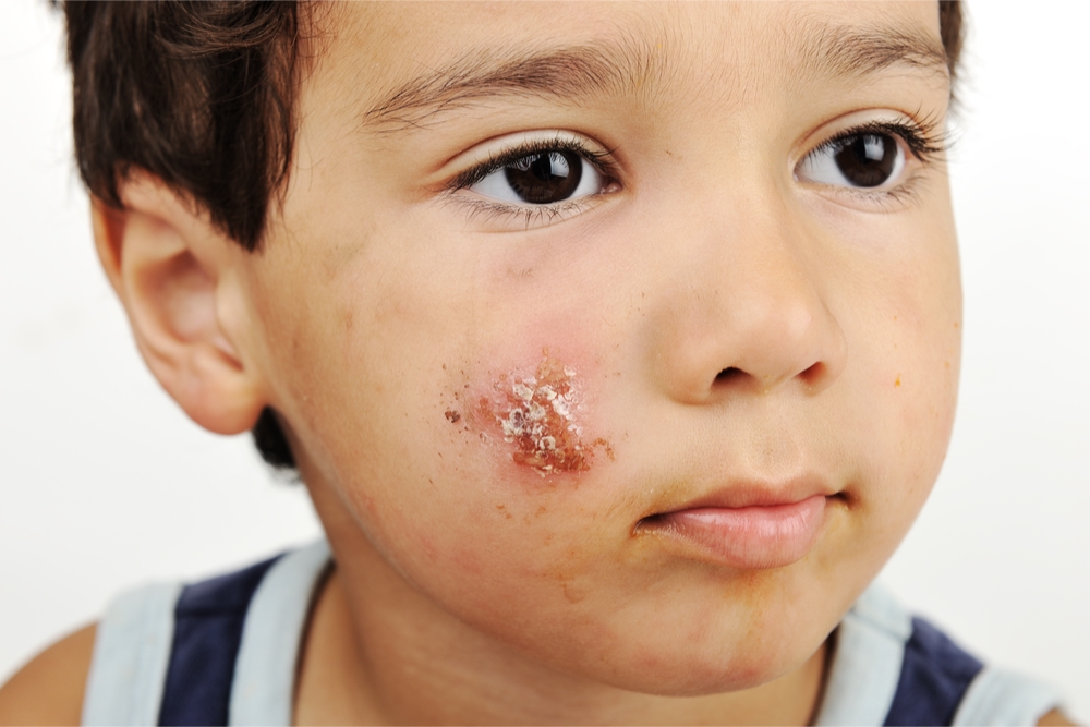 School Sores Symptoms Treatment Of Impetigo Qoctor Your Online Doctor