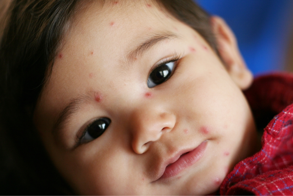 Chicken Pox symptoms & key facts Qoctor your online doctor