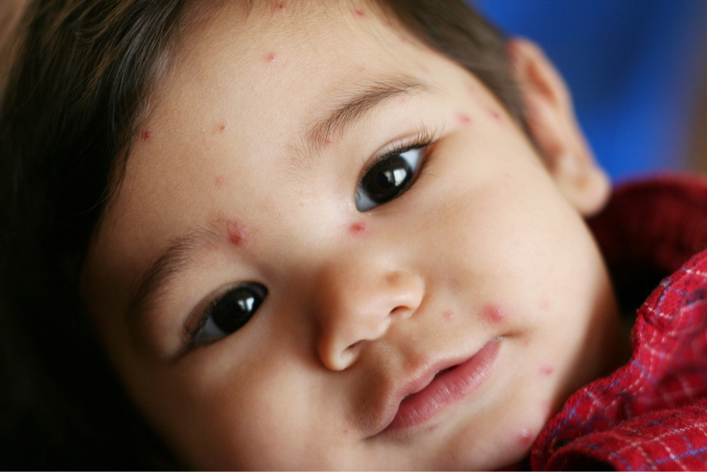 Chicken Pox In Hindi Symptoms