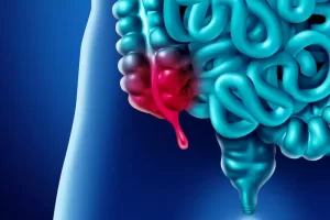 symptoms of appendicitis