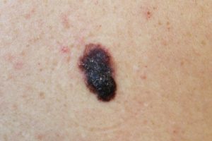 symptoms of melanoma- what does melanoma look like