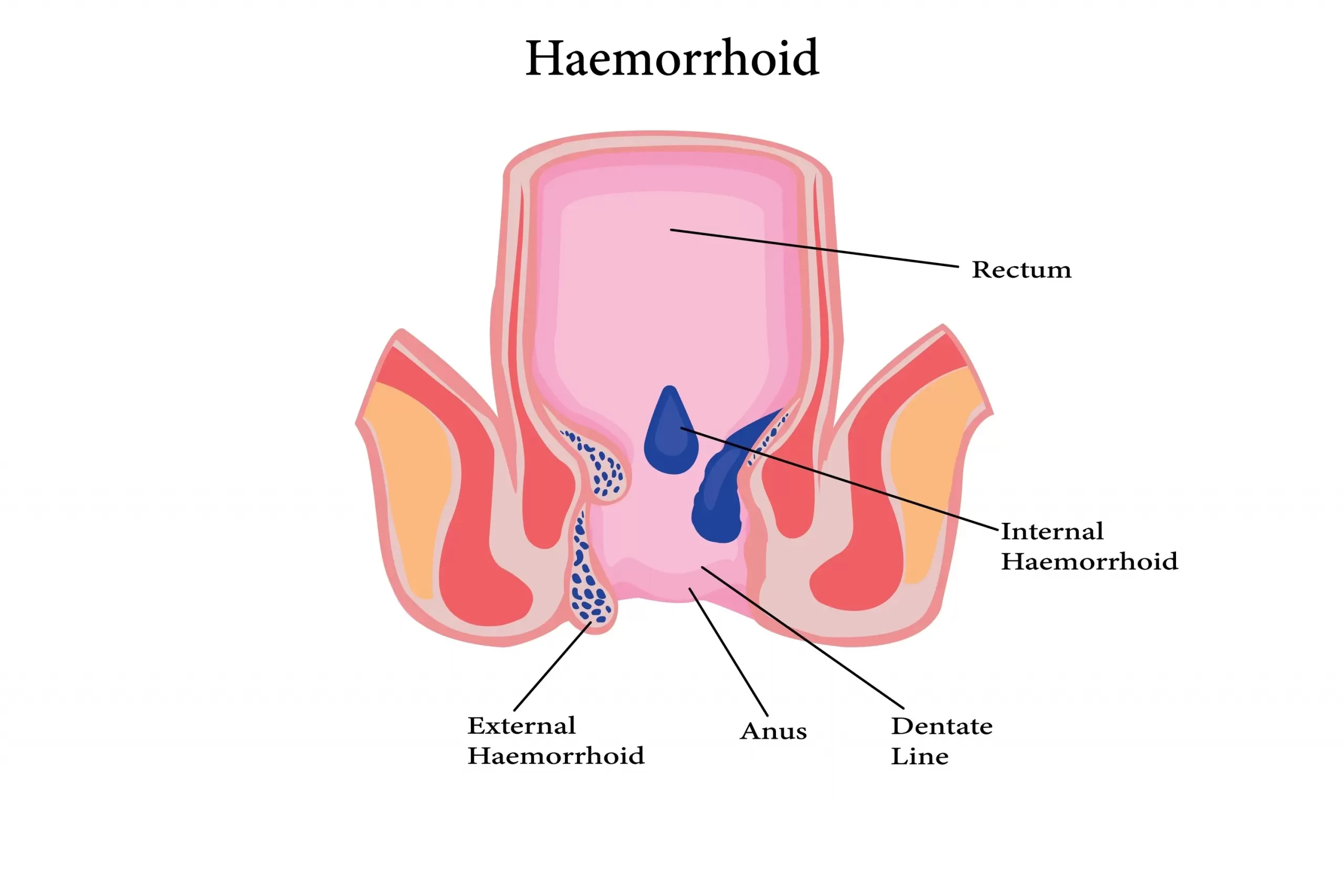 Illustration of the rectum and anal canal showing internal and external haemorrhoids