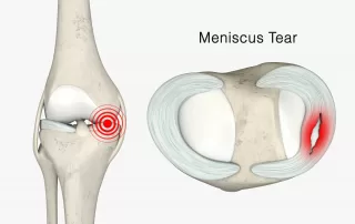 Meniscus Tear 3D Rendering
