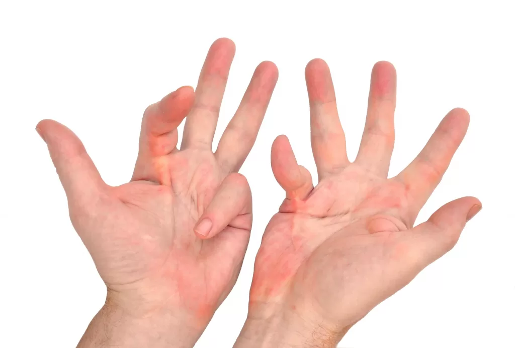 Affected fingers with Dupuytren's contracture showing difficulty to fully extend