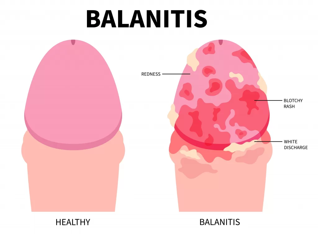 Image of a healthy penis against a penis with balanitis which shows redness of the head and white discharge