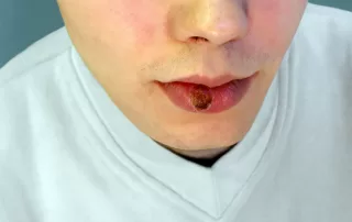 primary syphilis - indurated chancre on the lip