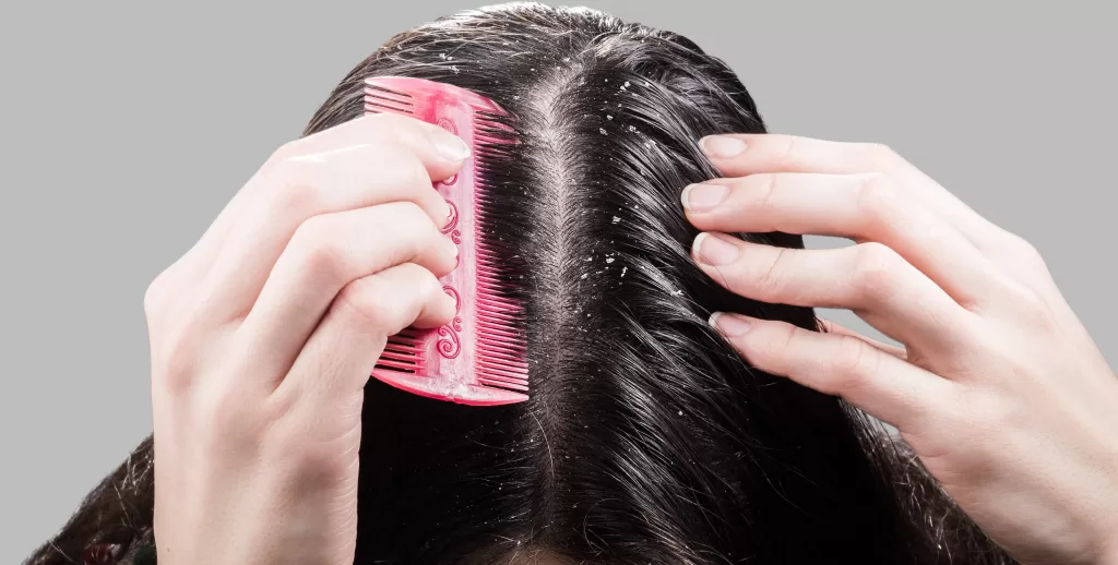 Woman removes dandruff from black hair with a comb